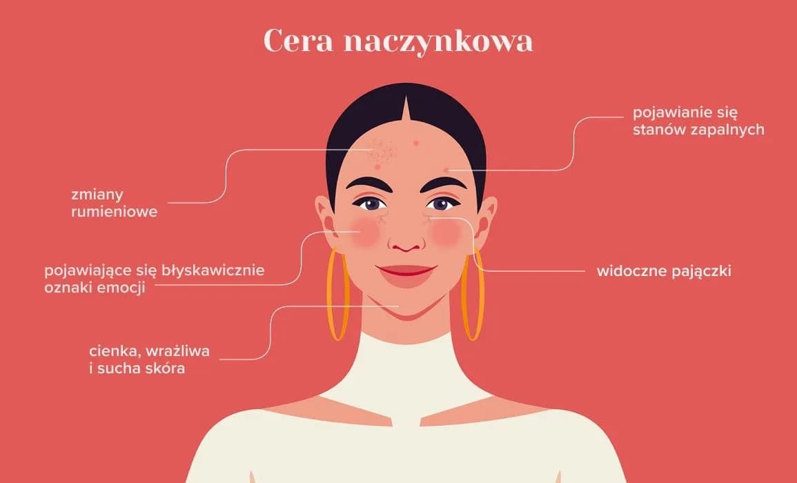 Cera naczynkowa: 7 objawów, które musisz znać - Poradnik