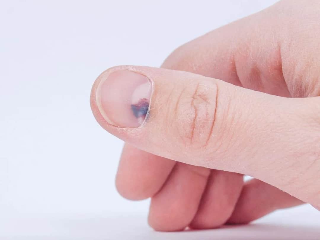 Co oznacza jeden czarny paznokieć? Przyczyny i leczenie