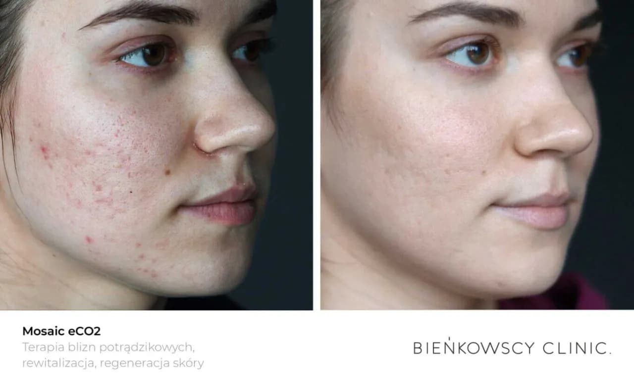 Skuteczne leczenie cery trądzikowej - sprawdzone metody i produkty